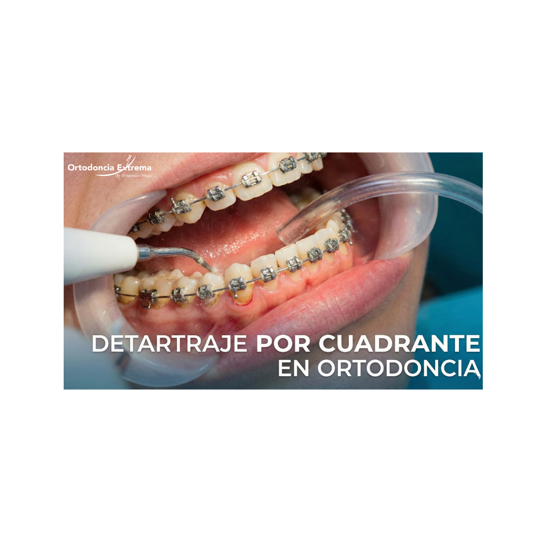 Detartraje Por Cuadrante - Image 3