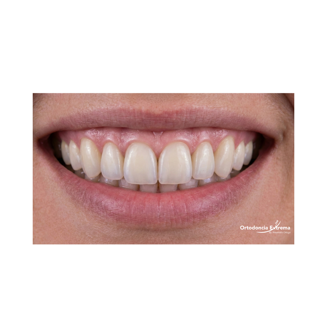 Diseño de Sonrisa con Coronas en Zirconio - Image 3