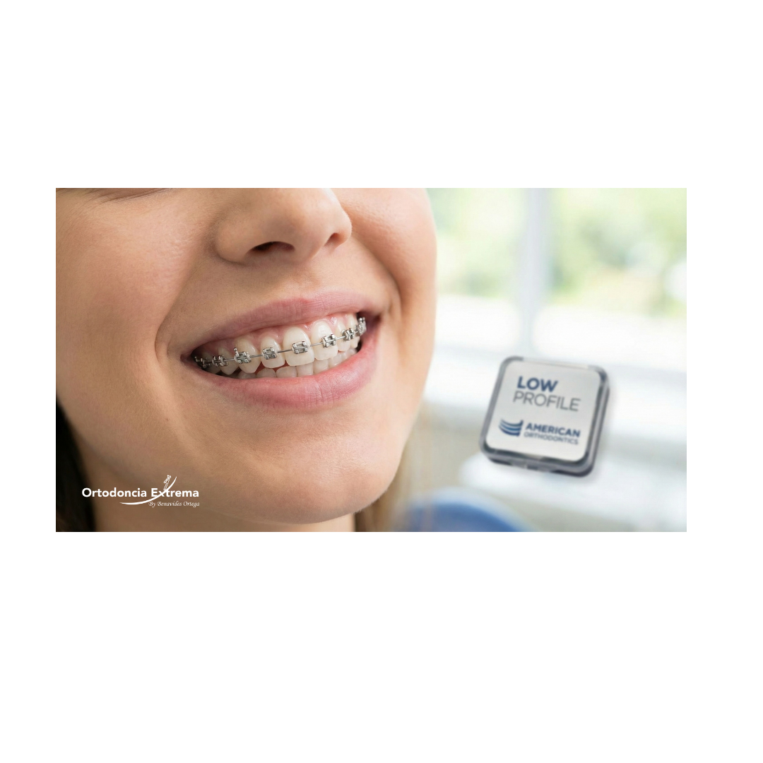 Tratamiento de Ortodoncia con Low Profile (Americanos) - Image 4