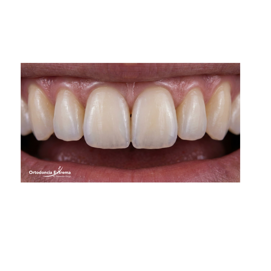 Diseño de Sonrisa con Resinas Estéticas - Image 2