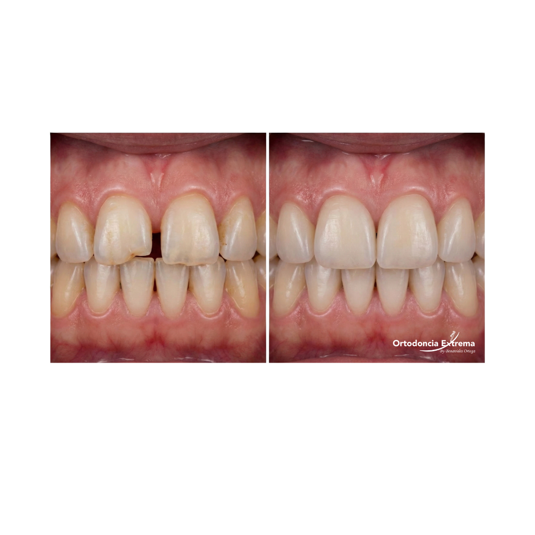 Diseño de Sonrisa con Resinas Estéticas - Image 3