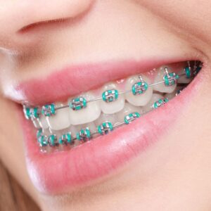 Tratamiento de Ortodoncia con Brackets Economical
