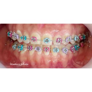 Tratamiento de Ortodoncia con Brackets Adhesión