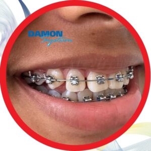Tratamiento de Ortodoncia con Brackets Damon