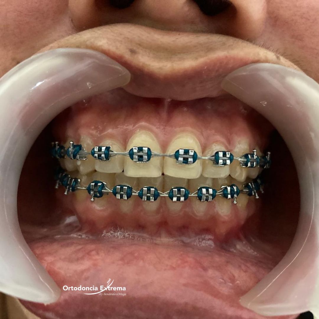 Tratamiento de Ortodoncia con Low Profile (Americanos)