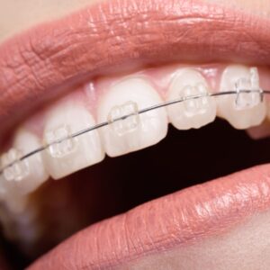 Tratamiento de Ortodoncia con Brackets de Zafiro