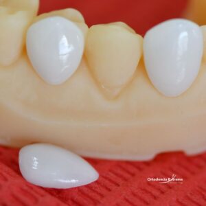 Diseño de Sonrisa con Carillas en Disilicato de Litio