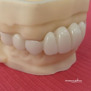 Diseño de Sonrisa con Coronas en Zirconio