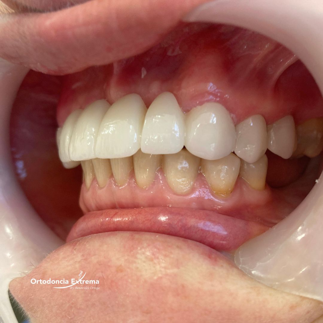 Diseño de Sonrisa con Coronas en Zirconio - Image 2