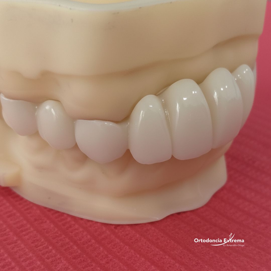 Diseño de Sonrisa con Coronas en Zirconio