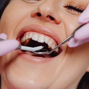 Detartraje Por Cuadrante