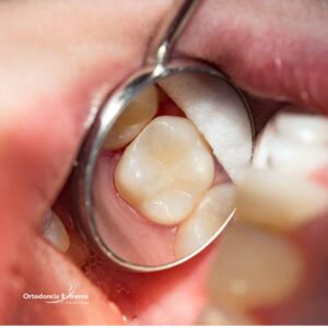 Calzas por Superficie